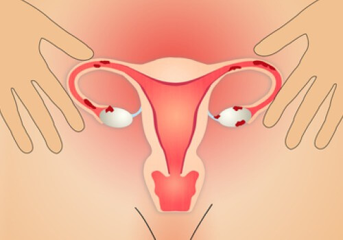 Endometriose: Sådan kan du spise dig rask!