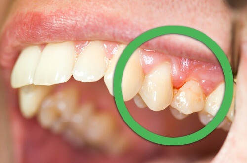 Sådan behandler du tandkødsbetændelse