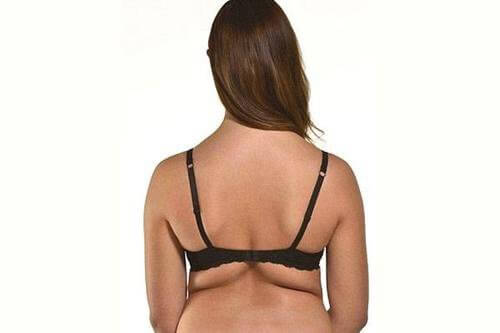 Kvinde med fedt paa ryggen