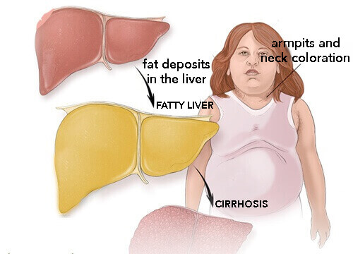 symptomer på fedtlever