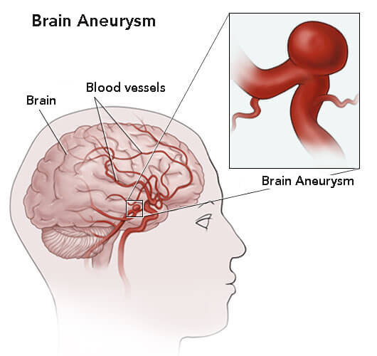Forebyg-Aneurismer-2