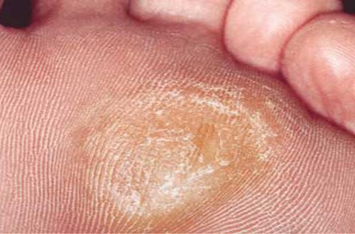 7 hjælpemidler til at fjerne hård hud og ligtorne på fødderne