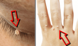 Fjern vorter naturligt