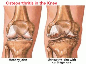 Symptomer og forebyggelse af gigt
