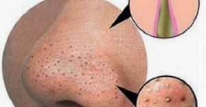 Sådan fjernes bumser og hudorme naturligt