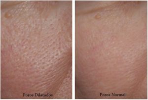 Forstørrede porer? Prøv disse 3 masker!