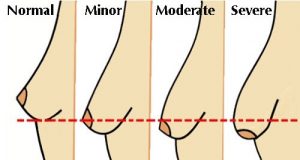 5 vaner, der får bryster til at hænge