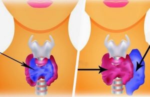 Forskellen mellem hypothyroidisme og hyperthyreoidisme