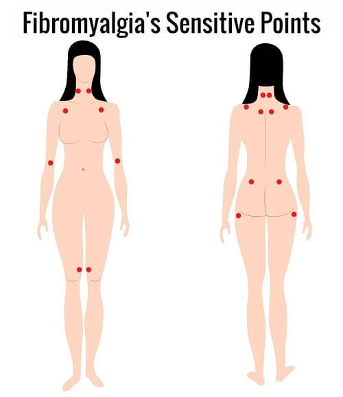 FibromyalgiSensitivePunkter