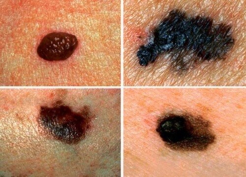 Sådan kan du opdage hudkræft inden det er for sent