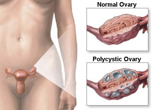 Naturlige lægemidler for polycystisk ovariesyndrom