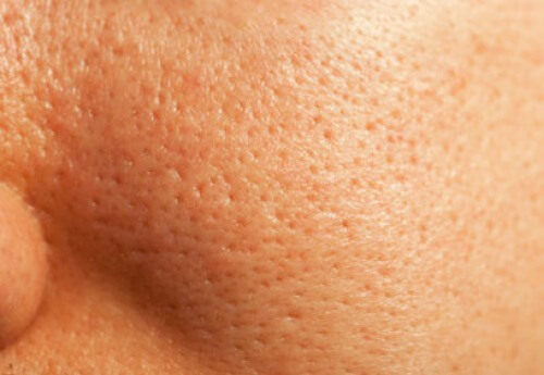 Hvordan du lukker porerne i din hud naturligt