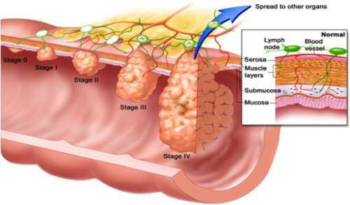 colon-polyp-3