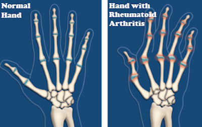 Haand der er normal og haand med slidgigt