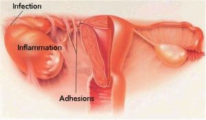 Symptomer på underlivsbetændelse