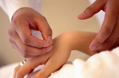 Kvinde der faar akkupunktur