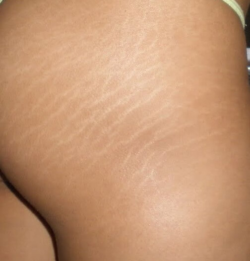 Numse med straekmaerker