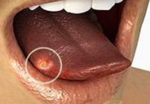 tongue-ulcer
