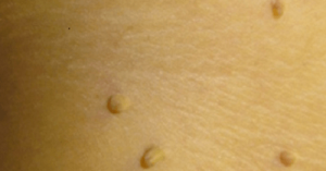 10 naturlige midler til at fjerne vorter skånsomt