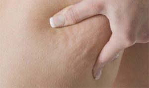 Undgå disse 7 fødevarer og kom af med cellulitis
