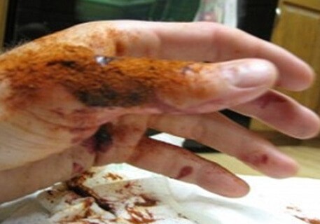 Vetigel: En gel, der stopper blødning på kun 10 sekunder