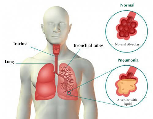 Symptomer på lungebetændelse og behandlinger