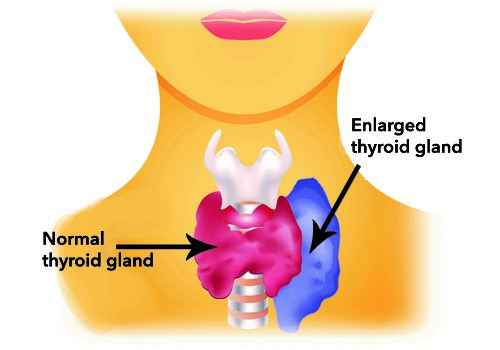 Nogle fødevarer kan hjælpe med at stimulere skjoldbruskkirtlen