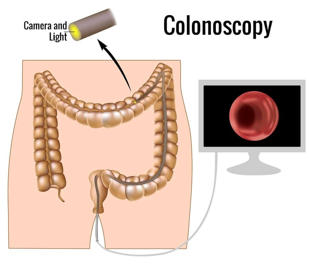 colonoskopi