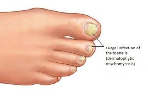 Hjemmelavede midler mod svampeinfektioner