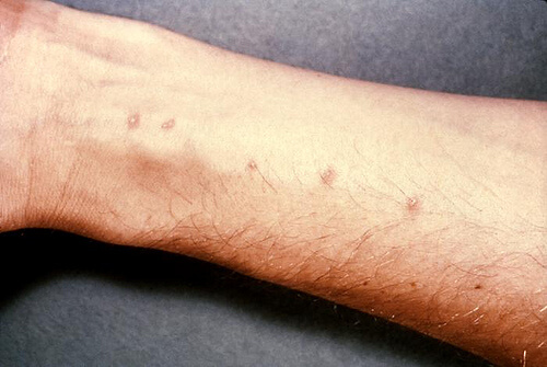 Hud allergi