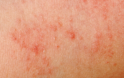 Hud allergi