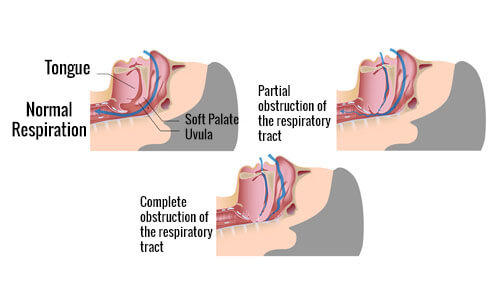 Oversigtstegning over en der snorker