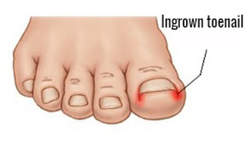 Indgroede tånegle er smertefulde og ubehagelige og kan lede til infektioner