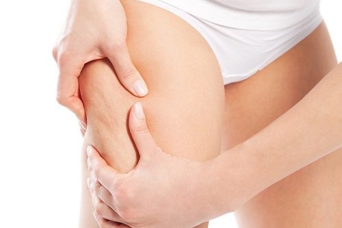 Kvinde med cellullitis