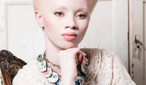 Albino-modellen Thando Hopas rørende fortælling