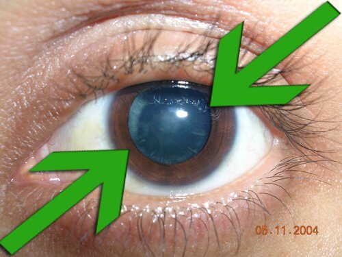 cataract2