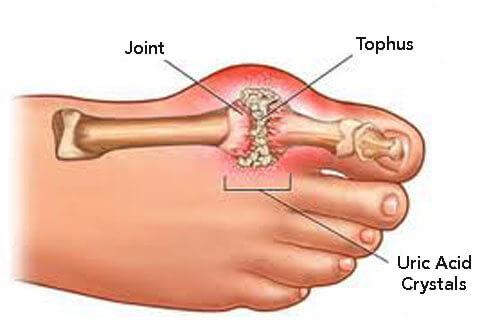 Urinsyrekrystaller sætter sig i leddene ig forårsager smerter og bevægelsesbesvær