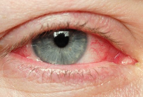 Krympe Villig kollision Prøv disse naturlige måder at lindre irriterede øjne - Bedre Livsstil