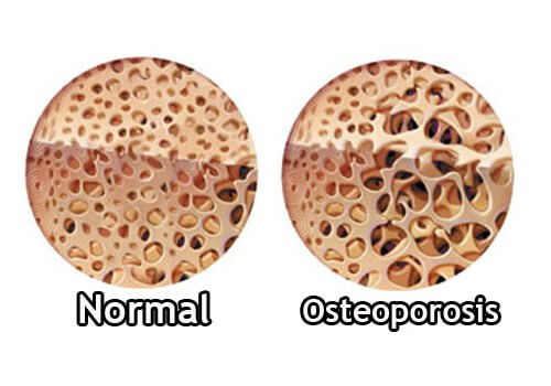 osteoporosis giver knoglesmerter