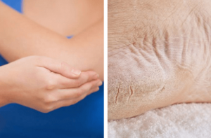 Slip af med tørre albuer og fødder på 1 uge