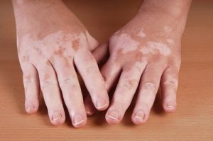 5 hjemmelavede midler mod vitiligo