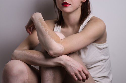 Der findes midler mod vitiligo, som du bør prøve, hvis du er træt af det brogede look