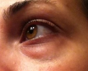 Sådan behandler du de mørke poser under øjnene naturligt