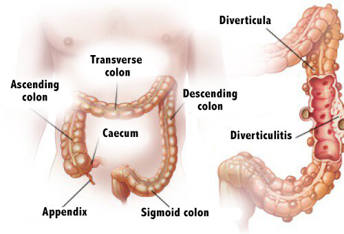 Diverticulitis og diverticulosis: Diagnose og behandling
