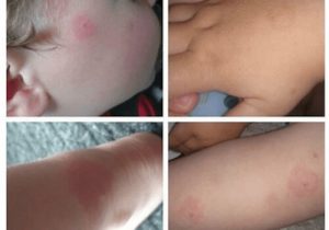 Borreliose og risiciene