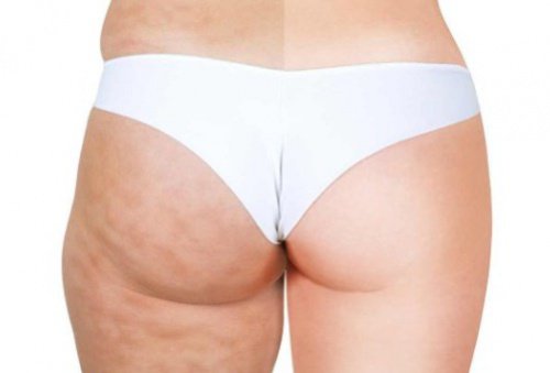 Cellulite foer og efter
