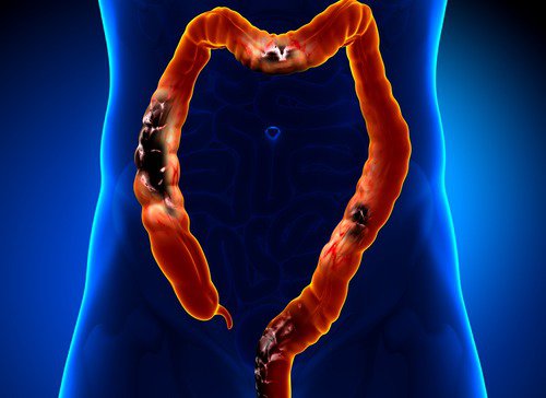 Diverticulosis