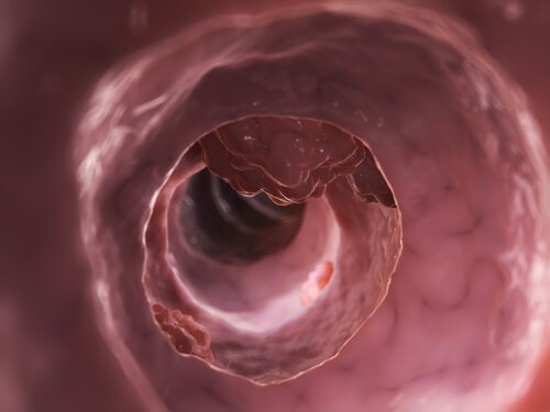 Tyktarm - diverticulitis og diverticulosis