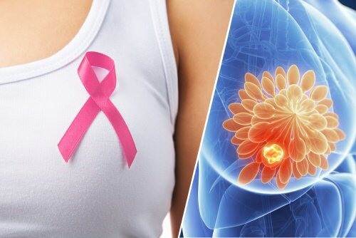 10 advarselstegn på brystkræft