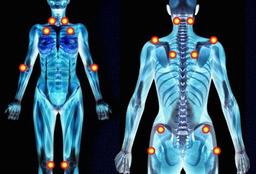 Fibromyalgi - smerter i arme og ben